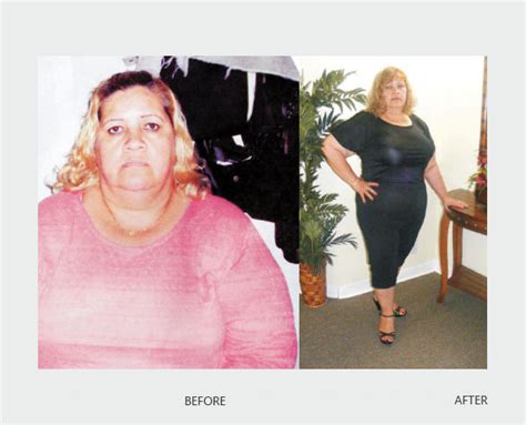 SculptorBody TM - Extreme Makeover Before & After