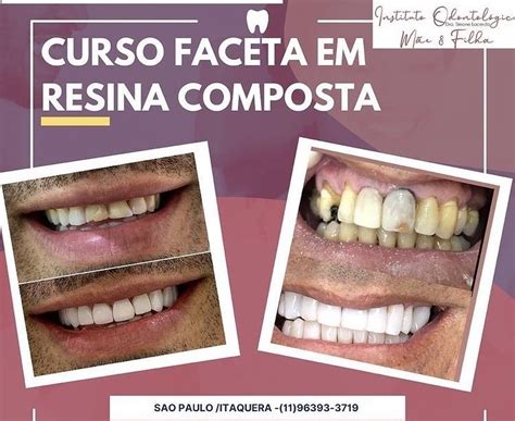 Curso De Faceta Em Resina Composta Simone Lacerda Vieira Marinho