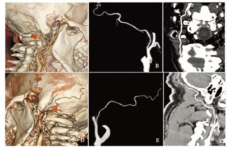 Comparison Of Different Image Reconstruction Methods In Msct