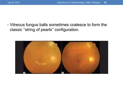 Infectious Uveitis Ppt