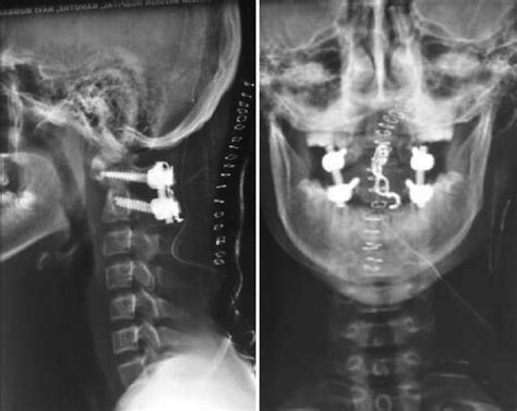 A Postoperative Lateral X‑ray B Anteroposterior X‑ray B A Download Scientific Diagram