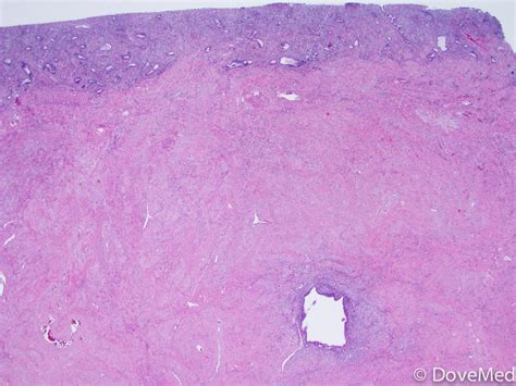 Adenomyosis