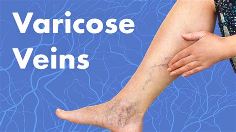 Varicose Veins Complications Treatment And Prevention Ausmed