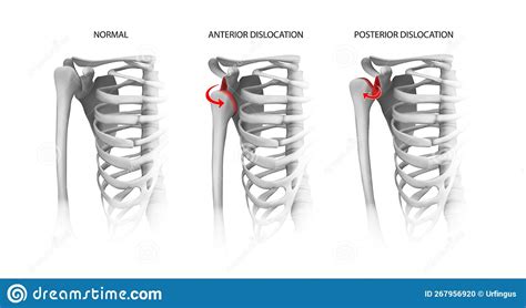 Shoulder Dislocation Anterior Dislocation Posterior Dislocation Labeled Royalty Free Stock