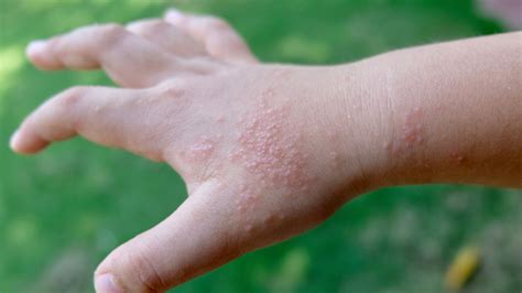 Dyshidrotic Eczema Blisters On The Hands Fingers And Feet