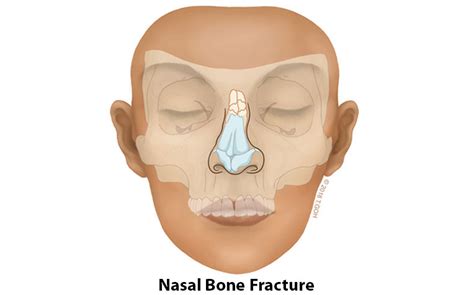 Broken Nose X Ray