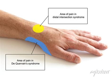 Compare Pain Area In Wrist Pain In De Quervains Syndrome And Cartazes