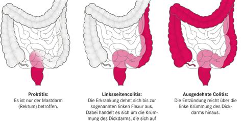 Ansatz Bungalow Kohlenhydrat colitis ulcerosa schleim Gang Möglichkeit