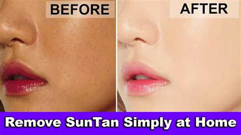 How To Remove Sun Tan Sun Tan Removal Whiten Your Skin At Home Youtube