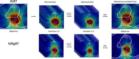 An In Silico Assessment Of The Dosimetric Benefits Of MR Guided