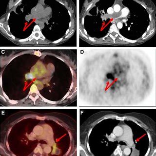 Surgical Specimen From Pulmonary Artery Sarcoma Resection Surgical