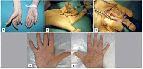 SciELO Brasil Surgical Treatment Results For Dupuytren S Disease