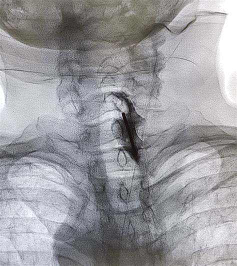 Complications Of Cervical Epidural Steroid Injection Anesthesia Key