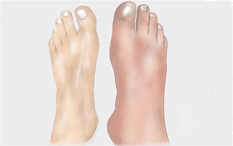 Morbus Sudeck - Anzeichen, Behandlung und Prognose.