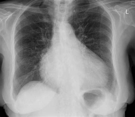 Mitral Stenosis Radiology Reference Article