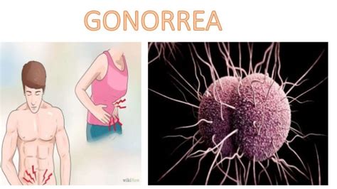 Gonorrea