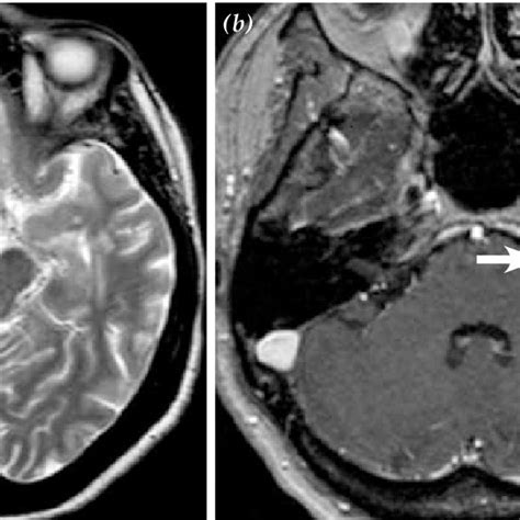 Axial Magnetic Resonance A T Weighted Non Contrast Image Showing