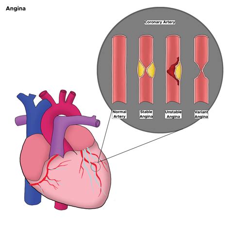 Figure Different Types Of Angina In Statpearls Ncbi Bookshelf