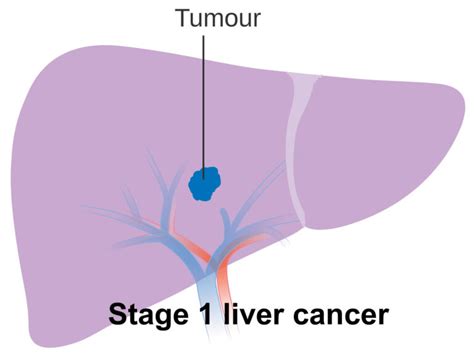 Liver Cancer Causes Symptoms Diagnosis Prognosis And Treatment