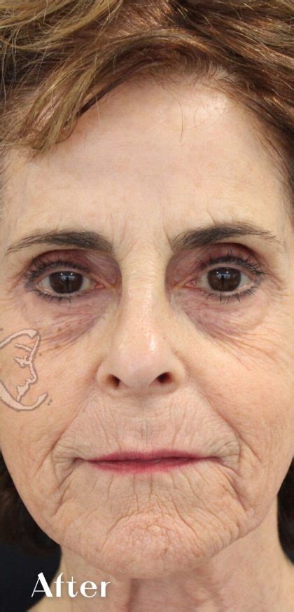 Patient 16198 Facial Rejuvenation Before And After Photos Santa Monica