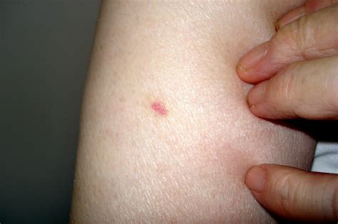 A Purple Papule In The Right Upper Extremity Copyrigh Open I