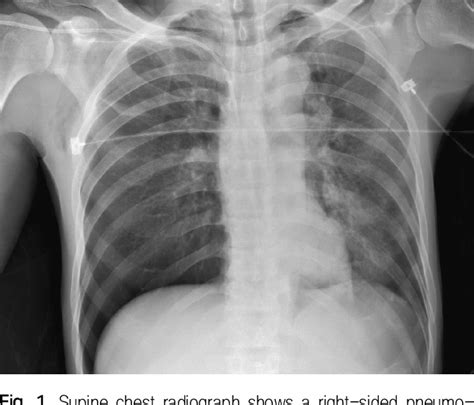 Figure 1 from Deep Sulcus Sign Developed in Patient with Multiple ...