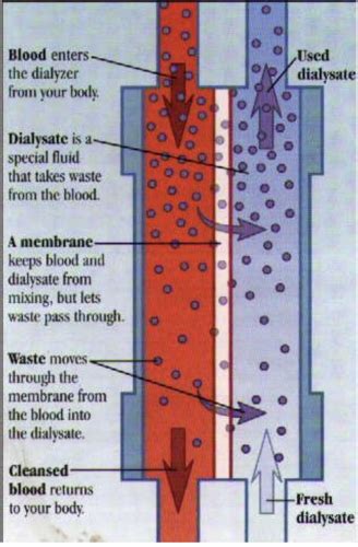 Dialysis Flashcards Quizlet