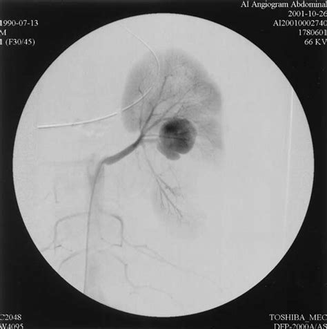 Selective Renal Artery Angiography Demonstrating A Pseudoaneurysm Of