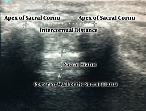 ultrasound image   sacral hiatus  intercornual distance