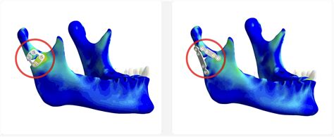 In Silico Medicine The Power Of CAE Biomedical Simulation