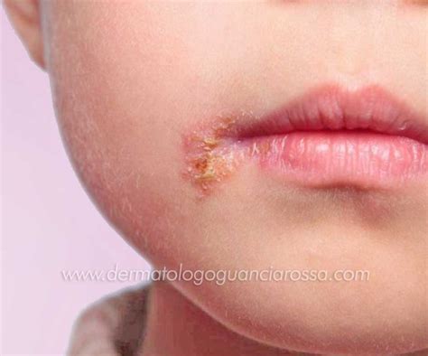 Dermatologia Pediatrica A Sant Ippolito E Fossombrone Dott Ssa