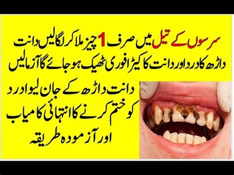 Teeth Pain Treatment In Urdu Teeth Cavity Removal At Home Dant Dard