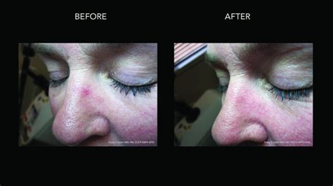 Rosacea Treatment Kelowna Facial Redness