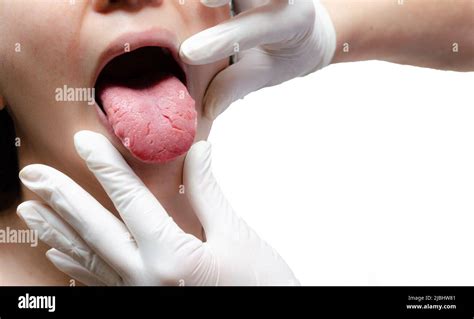 Tongue Of A Young Caucasian Woman With Benign Migratory Glossitis Held By A Doctor Wearing