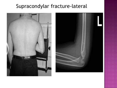 Radiographic Positioning Of Humerus And Shoulder