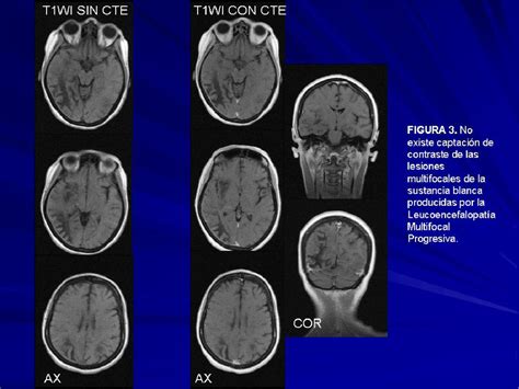 Figure 1 From Leucoencefalopatia Multifocal Progresiva Tras Tratamiento