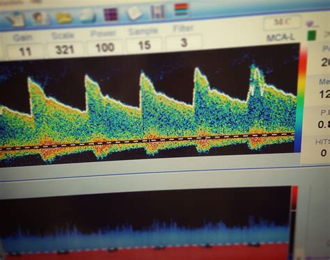 Transcranial Doppler Ultrasound Timing Critical for Beneficial Outcomes Following Stroke ...