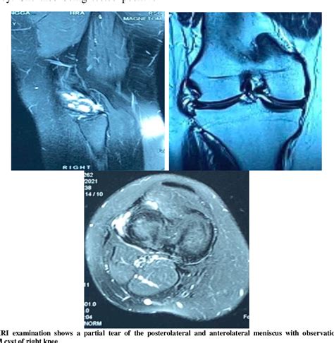 Figure 1 From Meniscal Repair And Parameniscal Cyst Excision With Knee