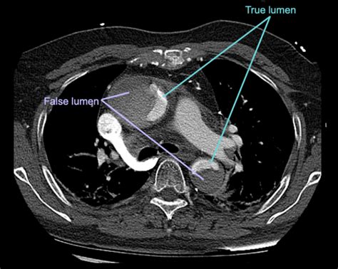 Ct Case Litfl Ct Scan Interpretation