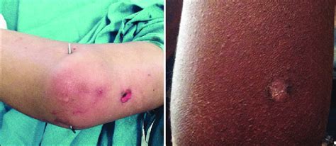 pin left  stab wound left unsutured  healed wound follow