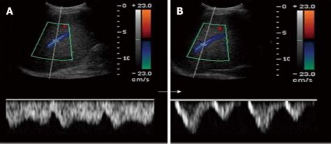 Doppler Ultrasonography Showing Change In The Hepatic Vein Waveform And