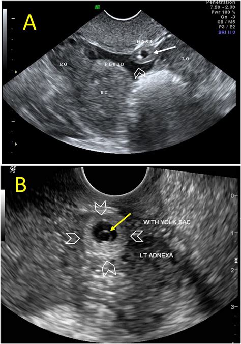 Transvaginal Ultrasound Scan Transvaginal Ultrasound Scan Revealed