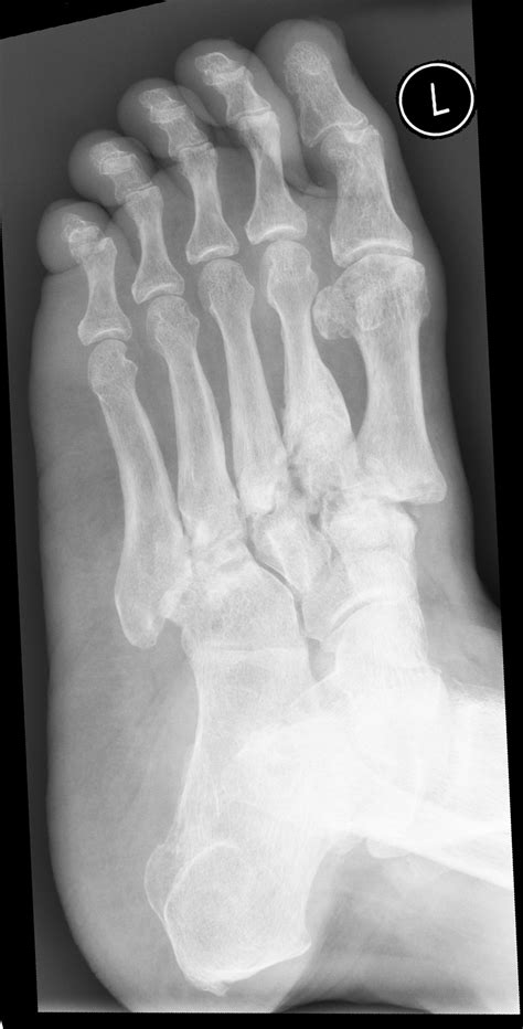 Lisfranc Fracture Dislocation In Charcot Foot Image Radiopaedia Org