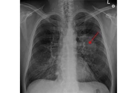 Small Cell Lung Cancer: Beating the Spread