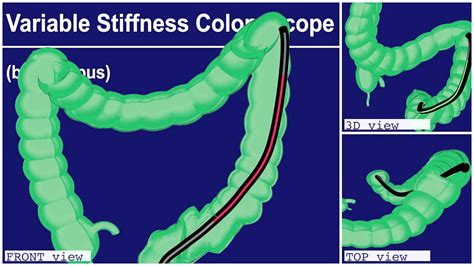 Colonscopy Video 3d Splenic Flexure Intubation Youtube