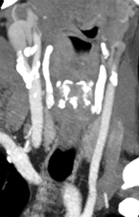 Stroke With Calcium Emboli Related To A Calcified Stenosis Of Internal