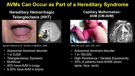 Hereditary Hemorrhagic Telangiectasia Tongue