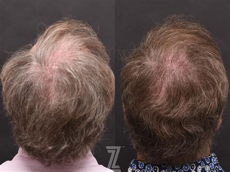 Exovex Before And After Photo Gallery Austin Tx The Piazza Center