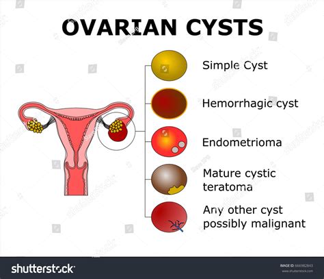 Different Types Ovarian Cyst