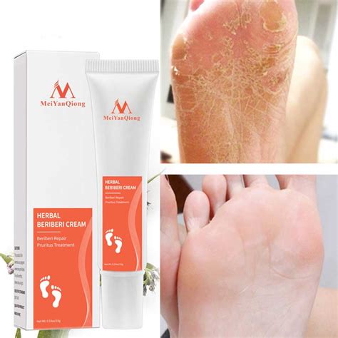 Ligghig 15ml Foot Cream Anti Fungal Infection Fungus Gel Repair Dry Crack Toe Treatment ...